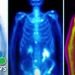 Prostate cancer cases on the rise