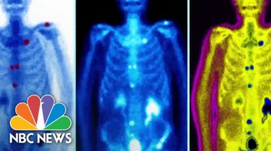 Prostate cancer cases on the rise
