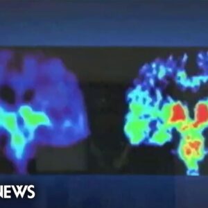 Trials show experimental cancer vaccine may slow growth of brain tumors