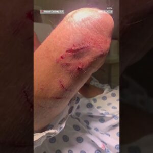 Swimmer was attacked by otters in a California lake