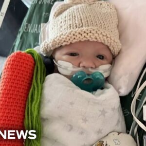 Infant born with rare heart defect receives first ever partial transplant